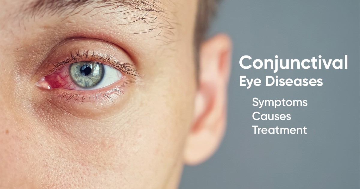 Conjunctival Eye Disease